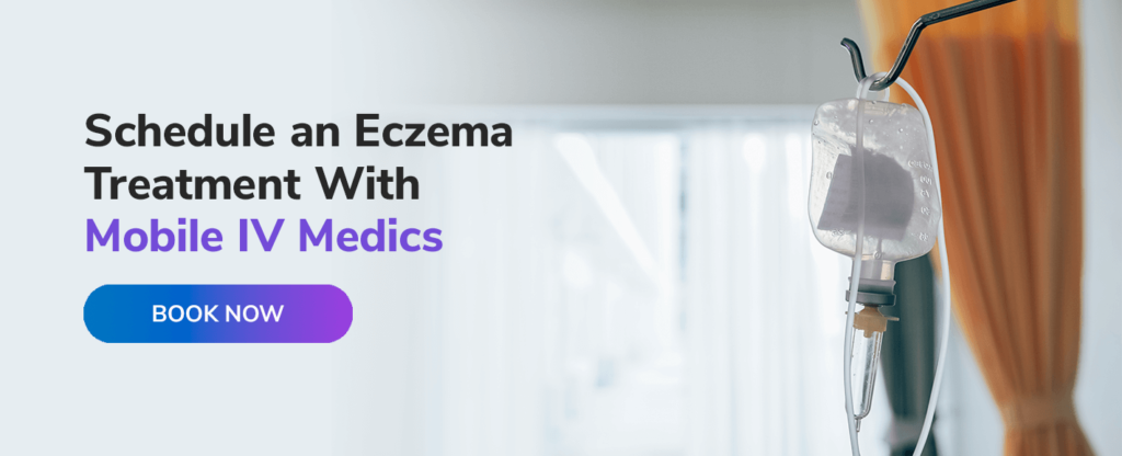 Which IV Therapy Treatment Helps Eczema? - | Mobile IV Medics
