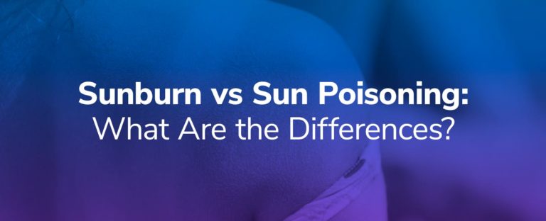 Sunburn vs. Sun Poisoning: What Are the Differences?