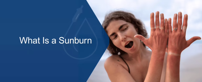 Sunburn: UV Damage, Fluid Loss, and Recovery