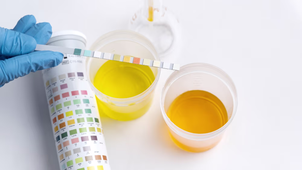 Urine color might not be a symptom of sunstroke and dehydration